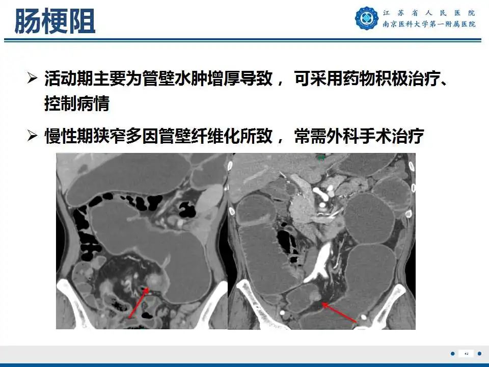 【PPT】克罗恩病-43