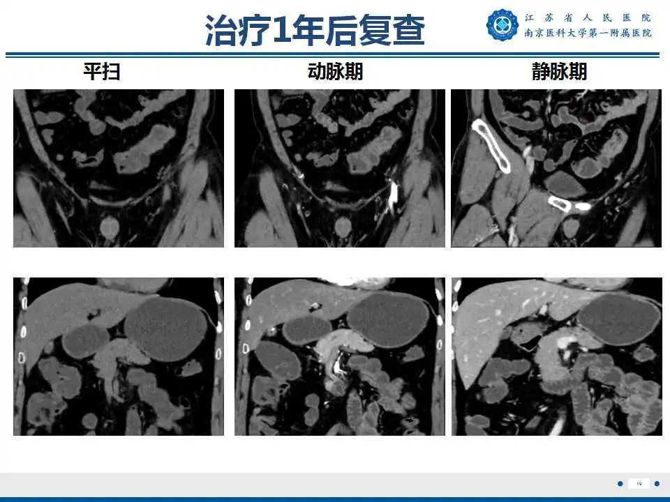 【PPT】克罗恩病-20