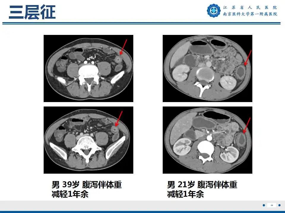 【PPT】克罗恩病-30