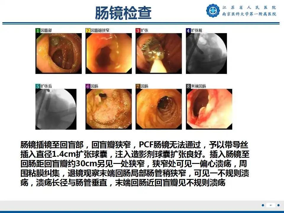【PPT】克罗恩病-52