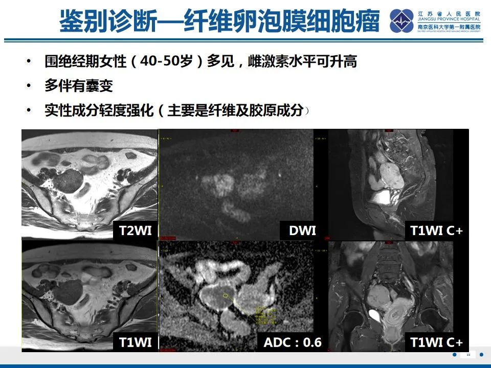 【PPT】盆腔孤立性纤维瘤-34