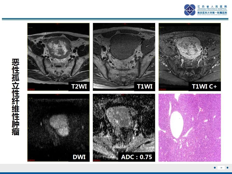 【PPT】盆腔孤立性纤维瘤-30