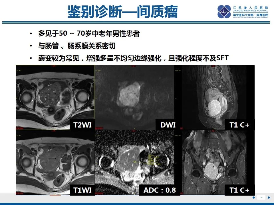 【PPT】盆腔孤立性纤维瘤-35