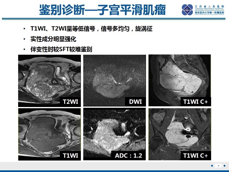 【PPT】盆腔孤立性纤维瘤-37