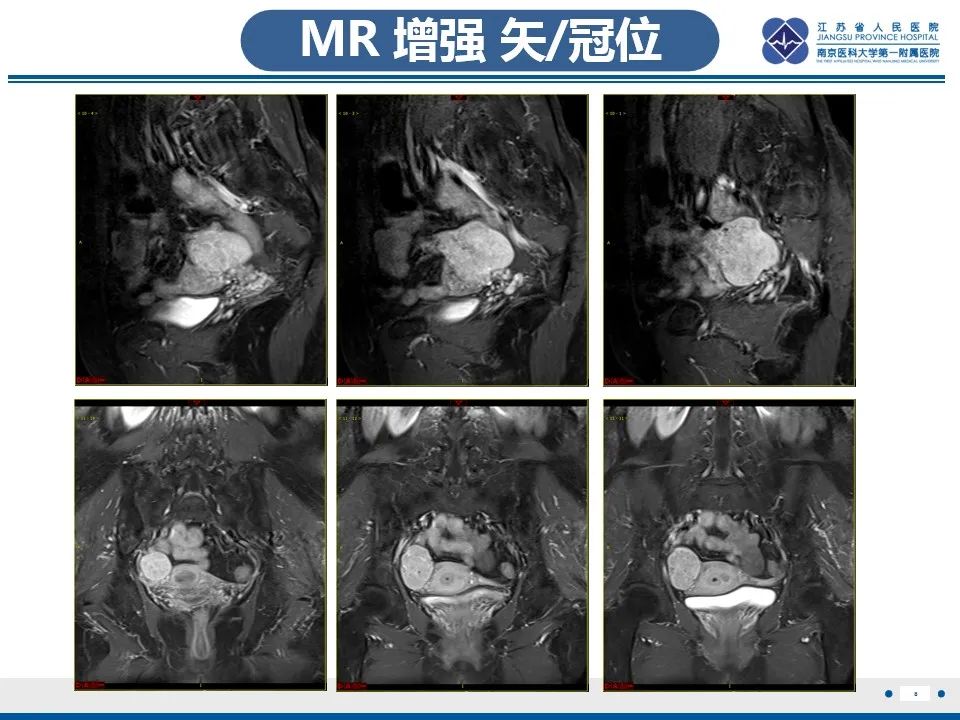 【PPT】盆腔孤立性纤维瘤-9