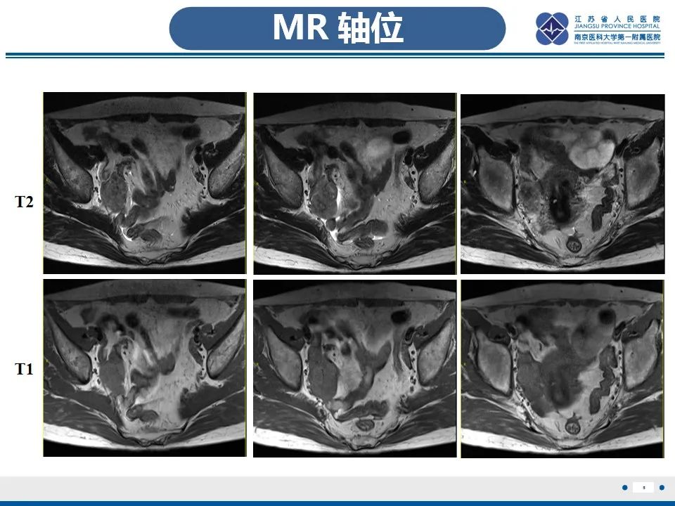 【PPT】盆腔孤立性纤维瘤-6