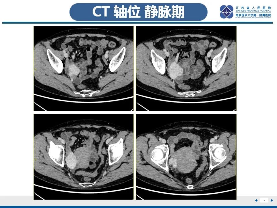 【PPT】盆腔孤立性纤维瘤-4