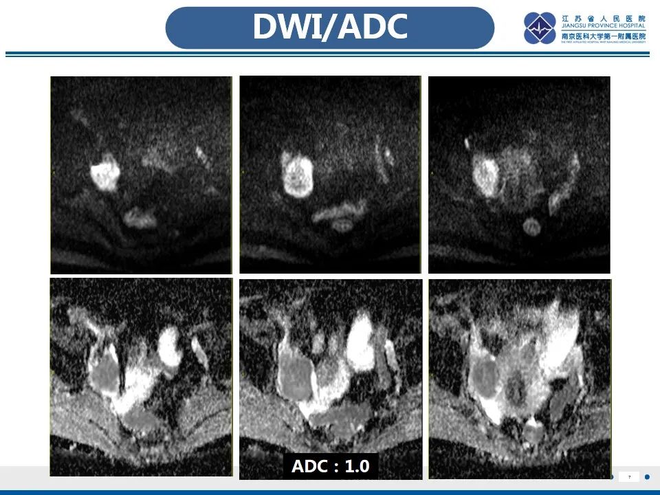 【PPT】盆腔孤立性纤维瘤-8