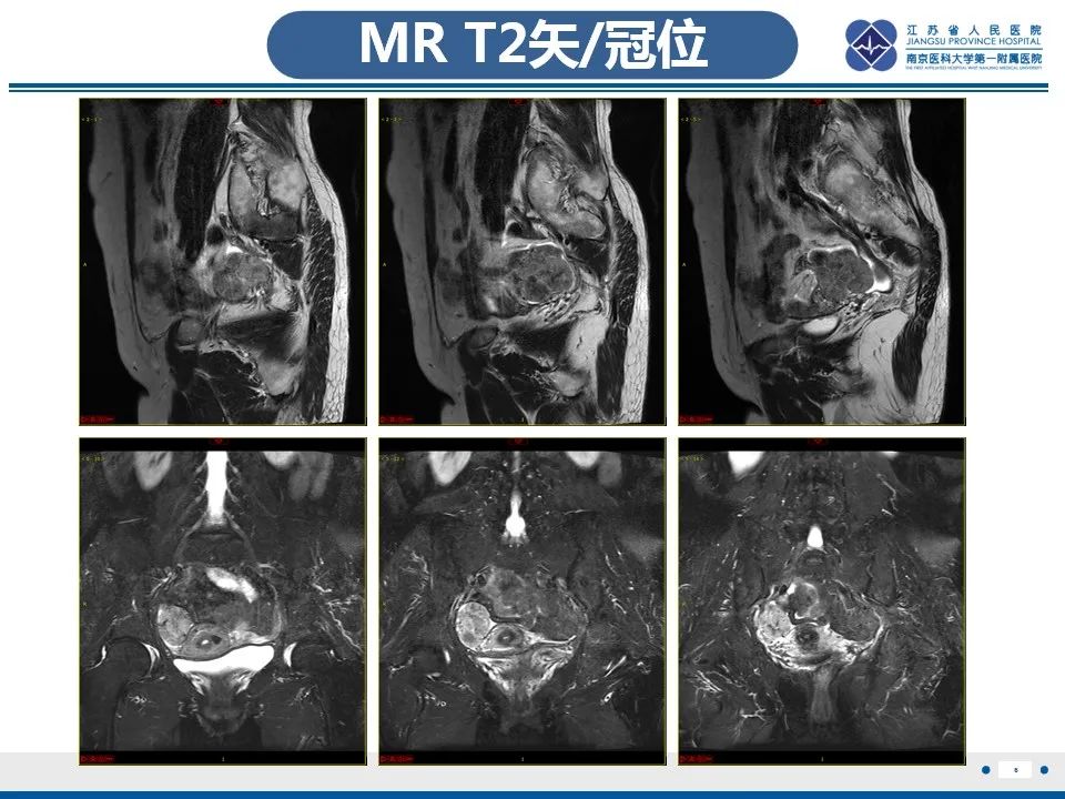 【PPT】盆腔孤立性纤维瘤-7