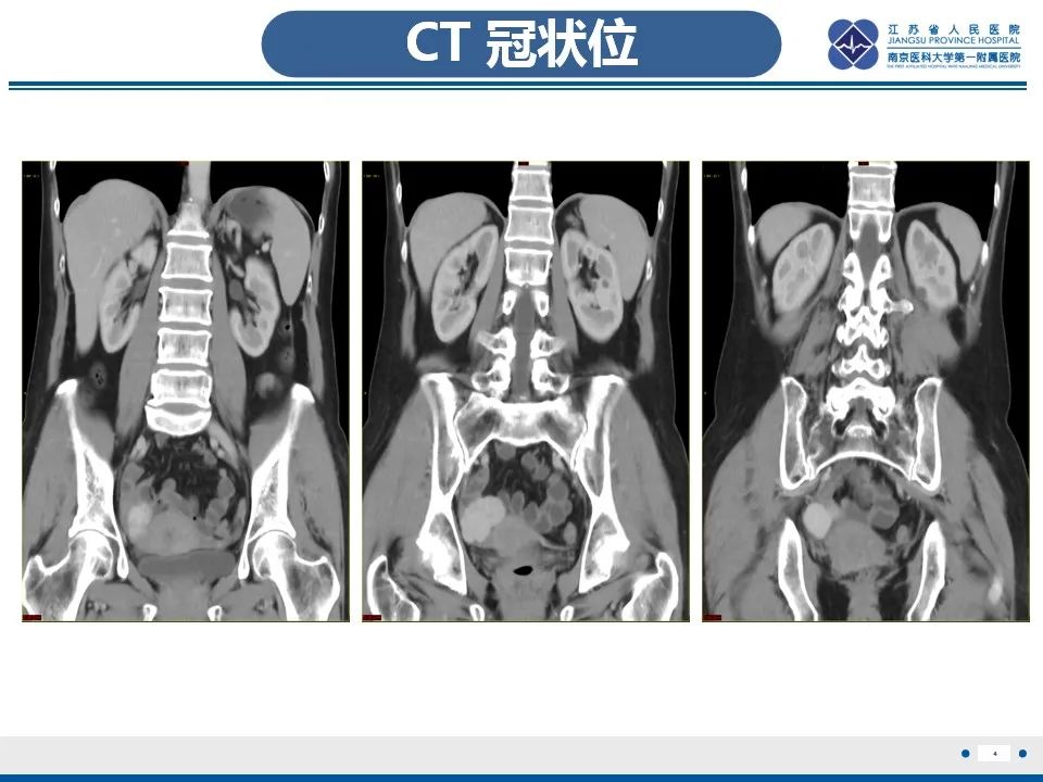 【PPT】盆腔孤立性纤维瘤-5