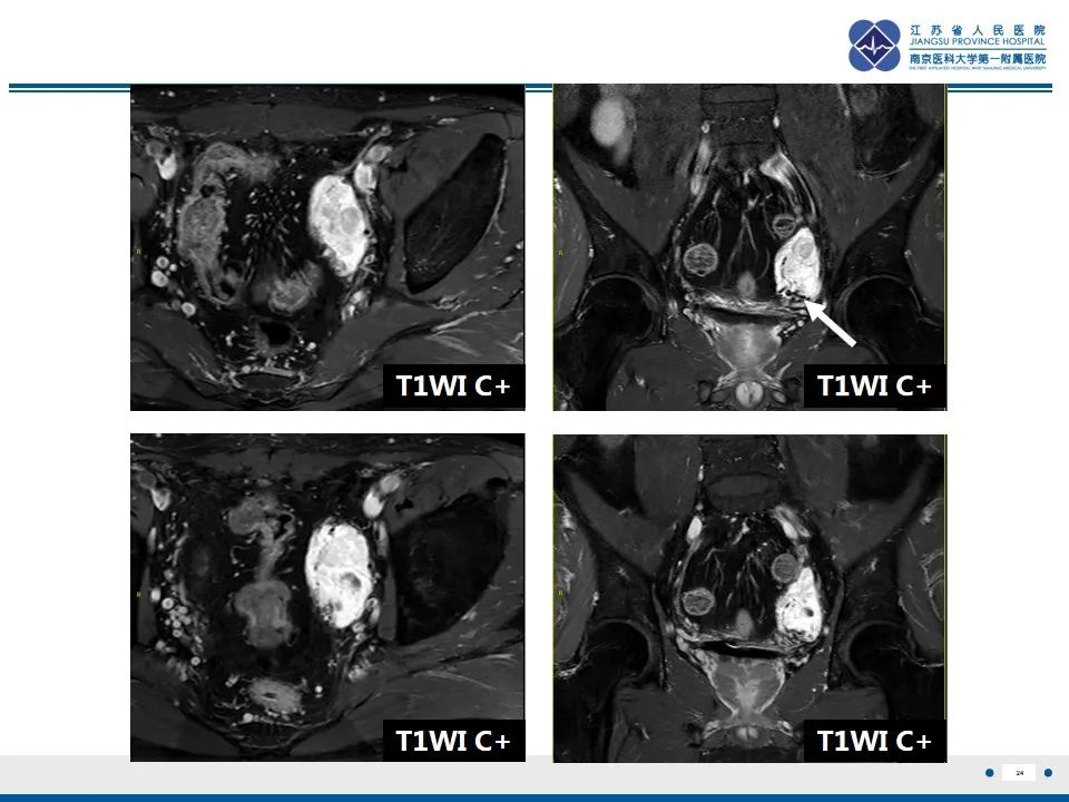 【PPT】盆腔孤立性纤维瘤-25