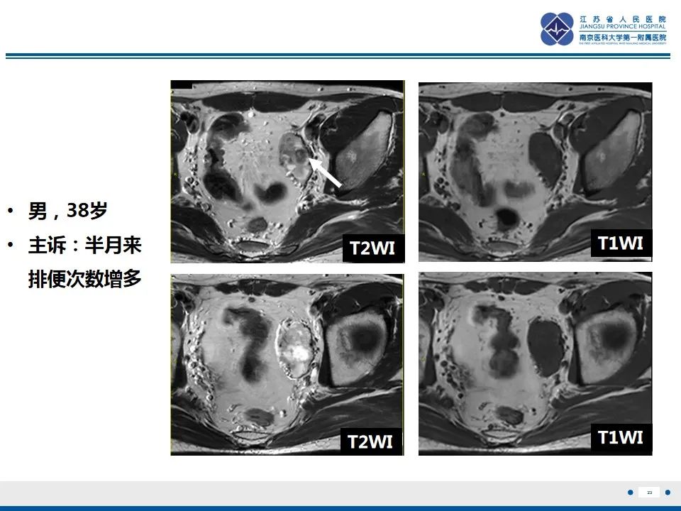 【PPT】盆腔孤立性纤维瘤-24