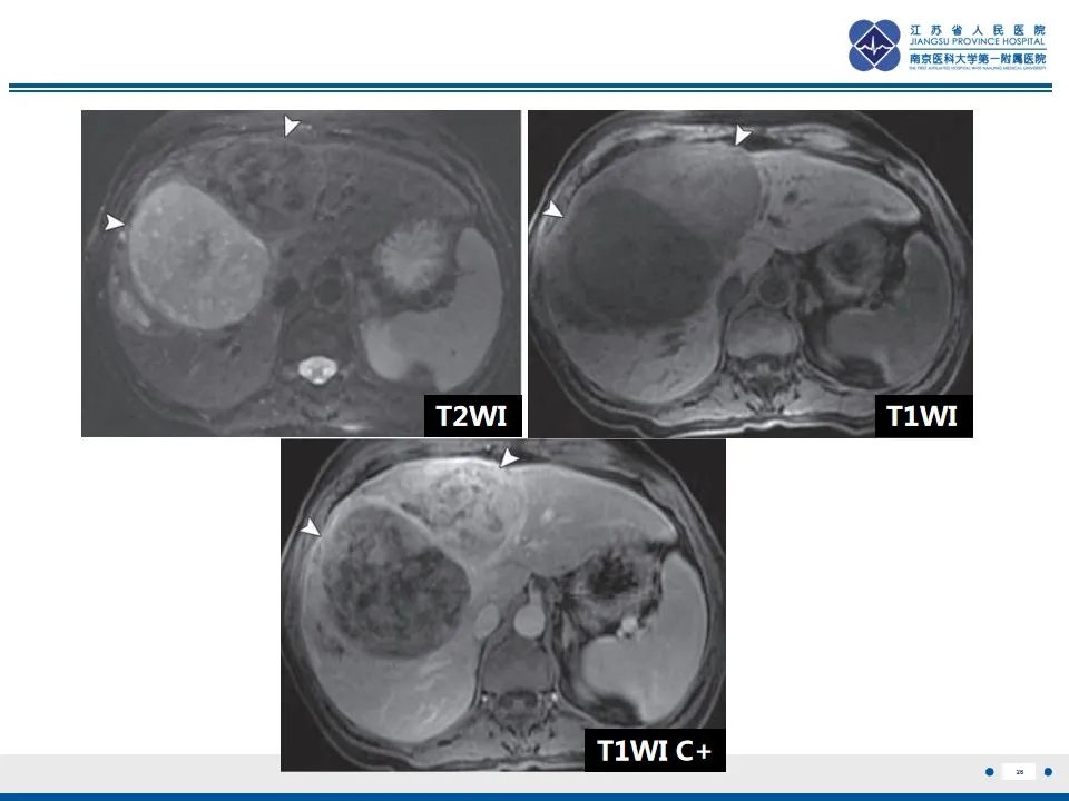 【PPT】盆腔孤立性纤维瘤-27