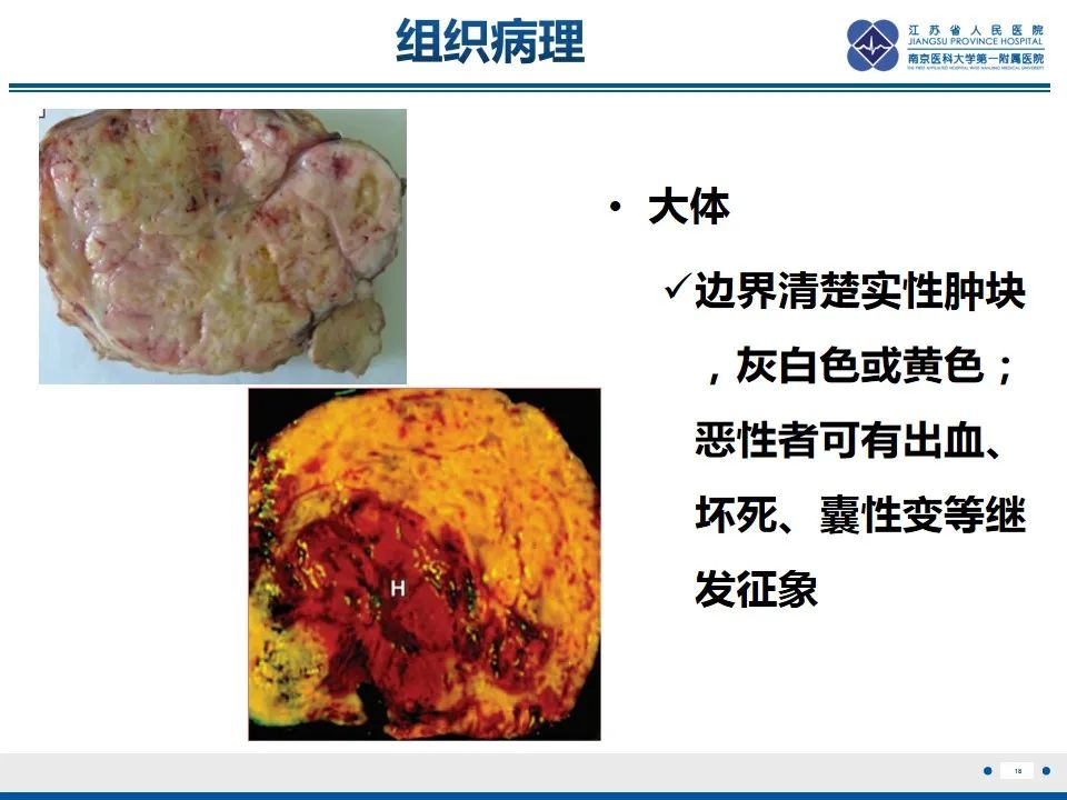 【PPT】盆腔孤立性纤维瘤-19