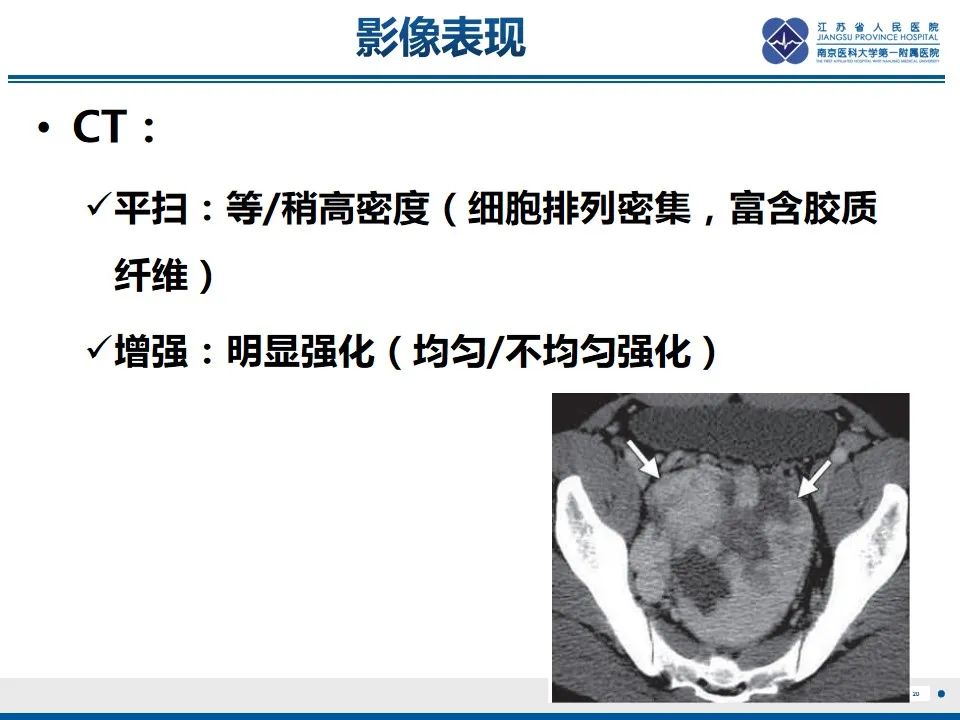 【PPT】盆腔孤立性纤维瘤-21