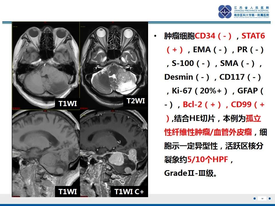 【PPT】盆腔孤立性纤维瘤-31