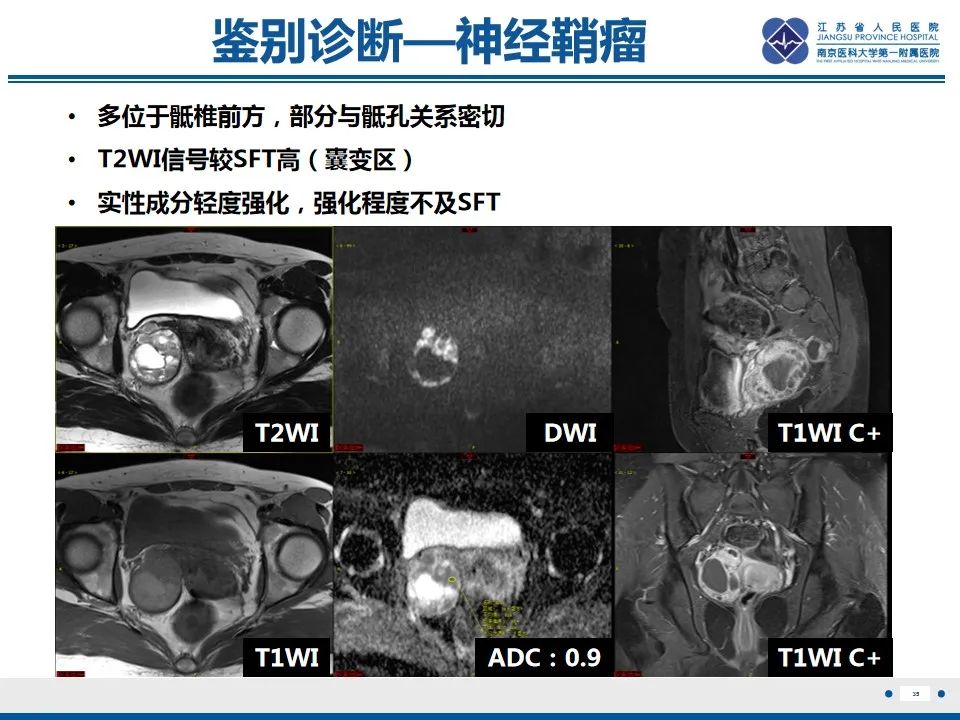【PPT】盆腔孤立性纤维瘤-36