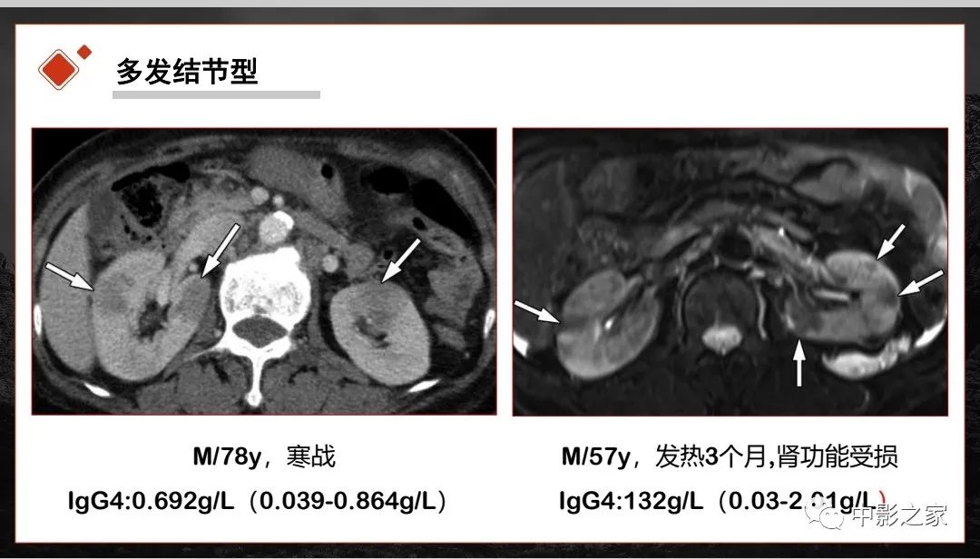 【PPT】肾脏IgG4-RD临床、病理及影像特征-15
