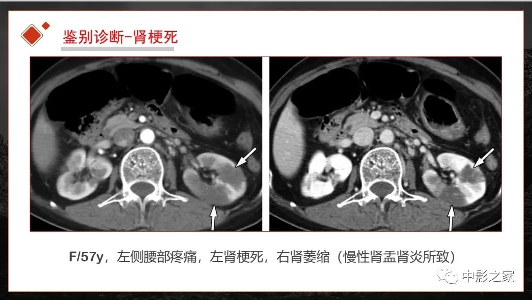 【PPT】肾脏IgG4-RD临床、病理及影像特征-27