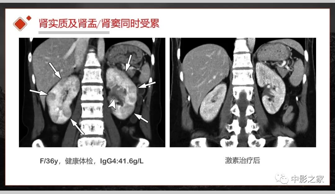 【PPT】肾脏IgG4-RD临床、病理及影像特征-32