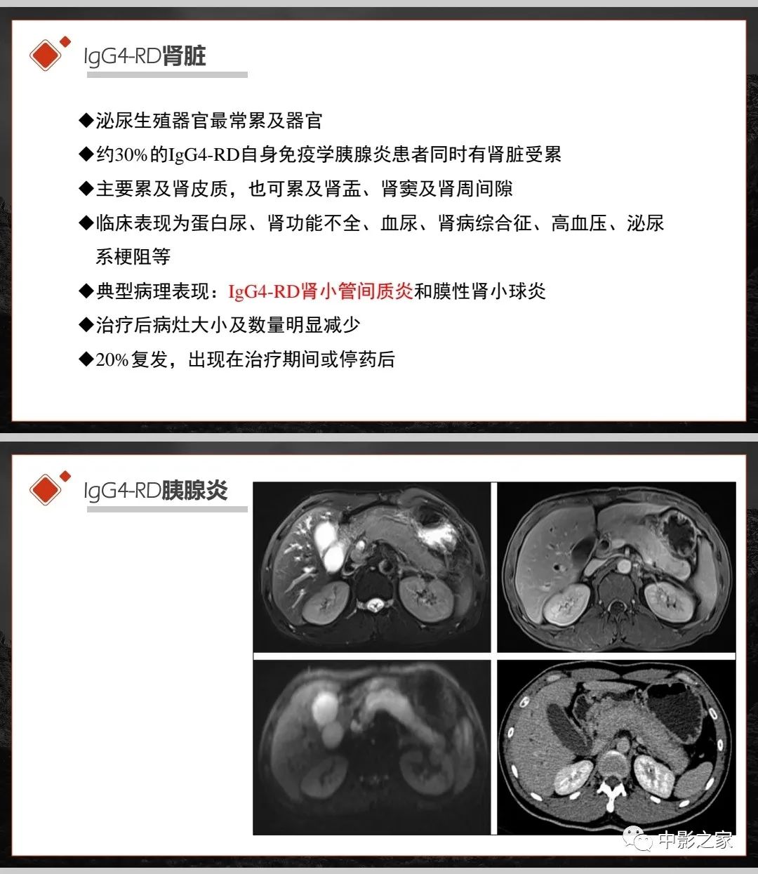 【PPT】肾脏IgG4-RD临床、病理及影像特征-9