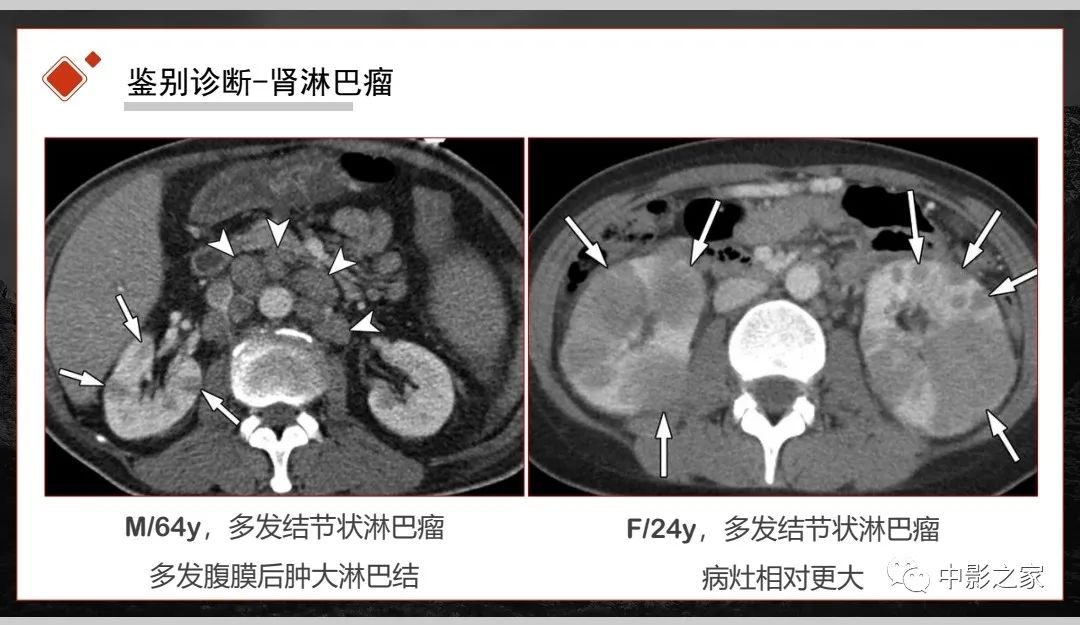 【PPT】肾脏IgG4-RD临床、病理及影像特征-23