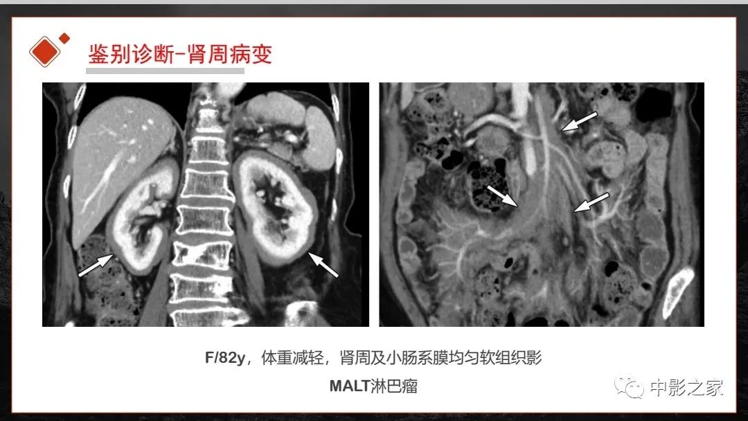 【PPT】肾脏IgG4-RD临床、病理及影像特征-37