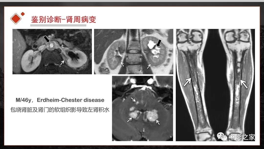 【PPT】肾脏IgG4-RD临床、病理及影像特征-39