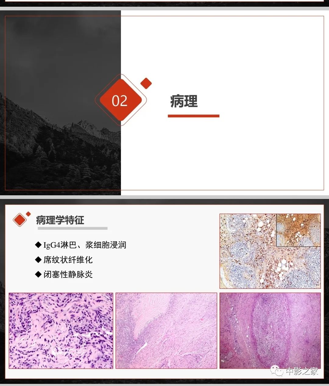 【PPT】肾脏IgG4-RD临床、病理及影像特征-6