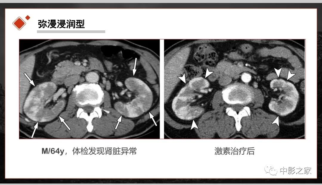 【PPT】肾脏IgG4-RD临床、病理及影像特征-18