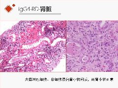 肾脏IgG4-RD临床、病理及影像特征