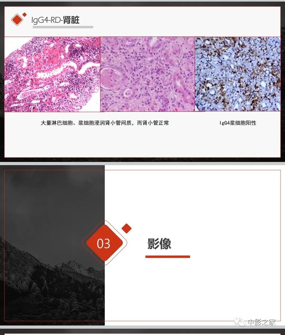 【PPT】肾脏IgG4-RD临床、病理及影像特征-8