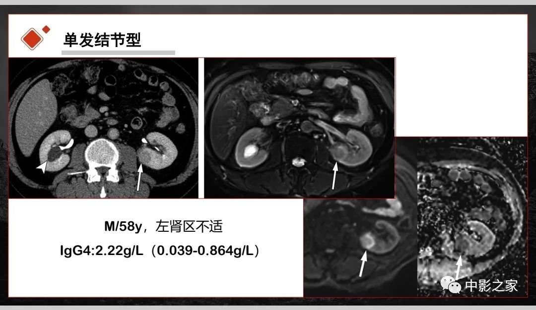 【PPT】肾脏IgG4-RD临床、病理及影像特征-20