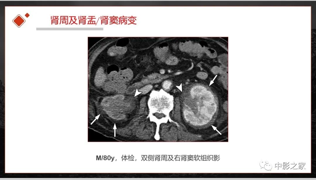 【PPT】肾脏IgG4-RD临床、病理及影像特征-33