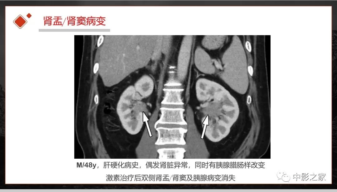 【PPT】肾脏IgG4-RD临床、病理及影像特征-31