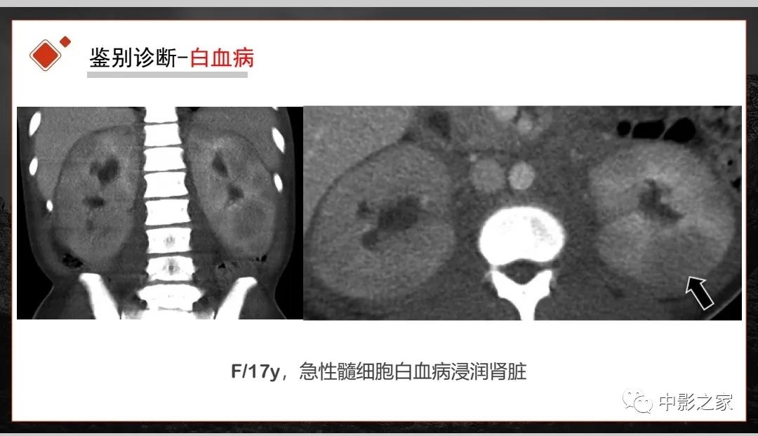 【PPT】肾脏IgG4-RD临床、病理及影像特征-28