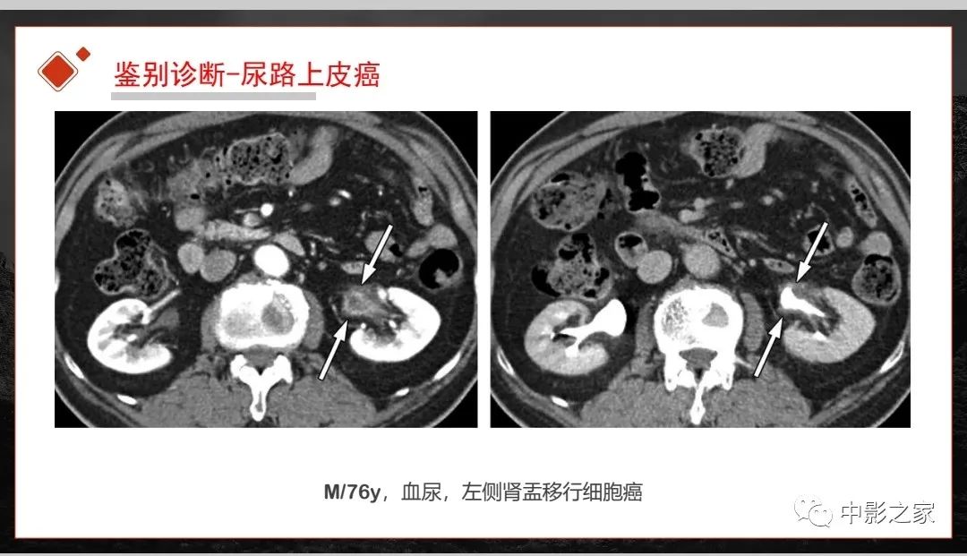 【PPT】肾脏IgG4-RD临床、病理及影像特征-36
