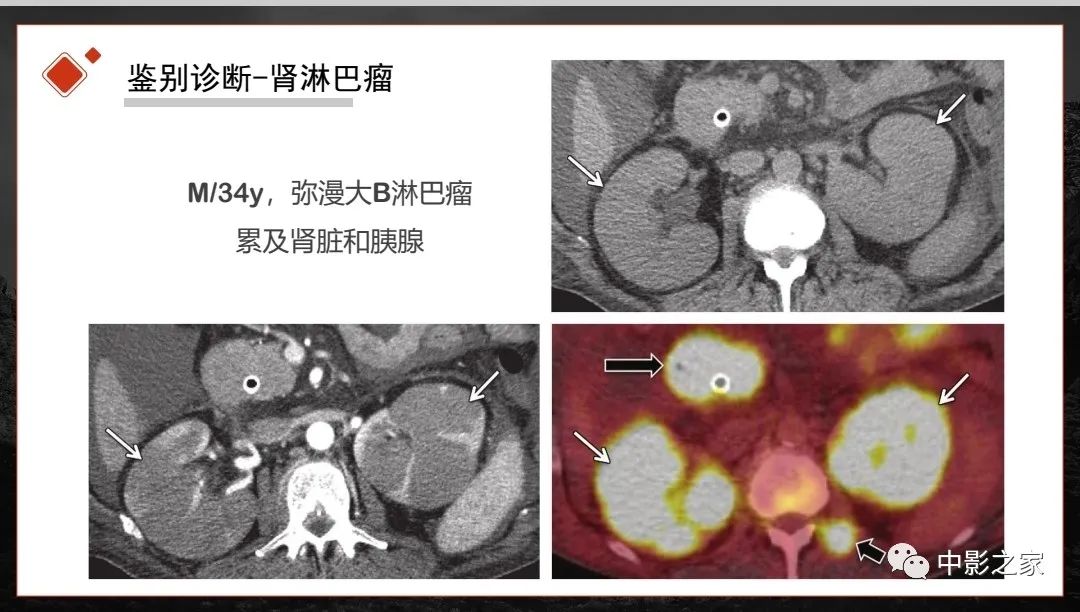 【PPT】肾脏IgG4-RD临床、病理及影像特征-24