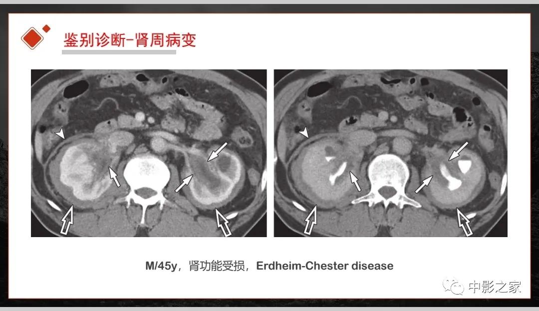 【PPT】肾脏IgG4-RD临床、病理及影像特征-38