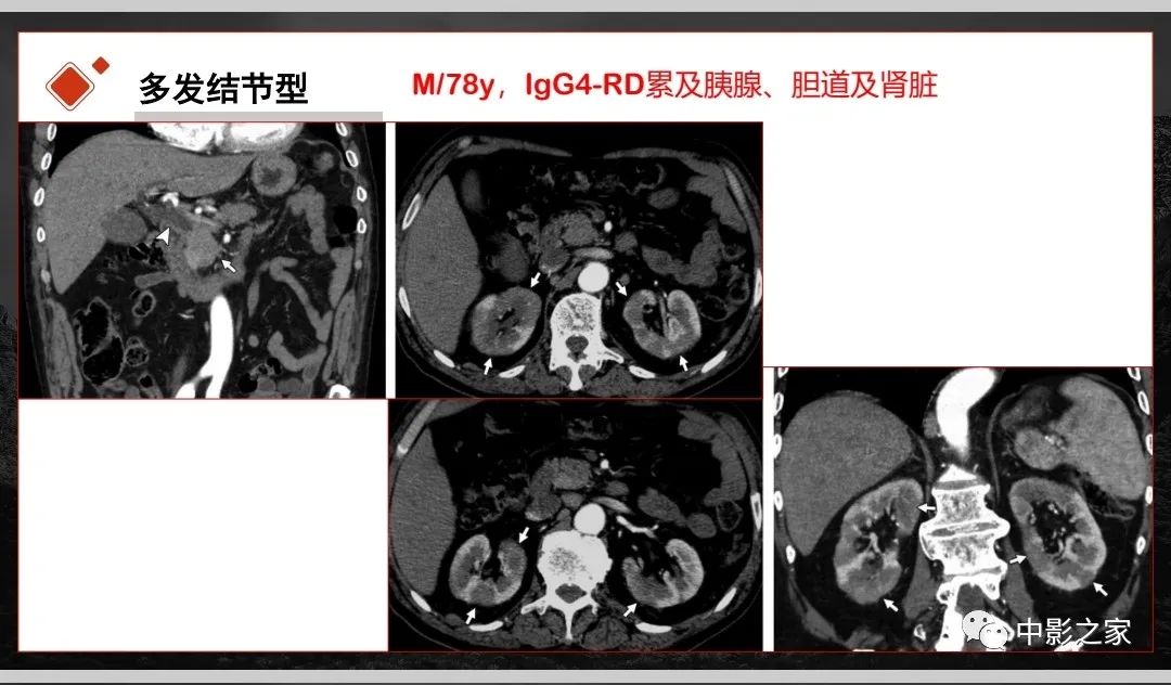 【PPT】肾脏IgG4-RD临床、病理及影像特征-17