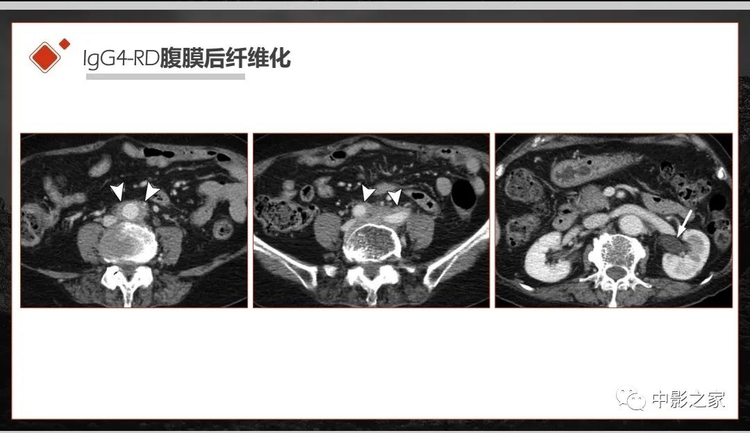 【PPT】肾脏IgG4-RD临床、病理及影像特征-12