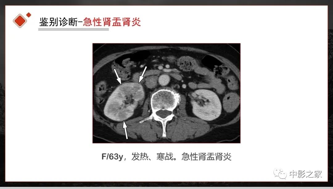 【PPT】肾脏IgG4-RD临床、病理及影像特征-26