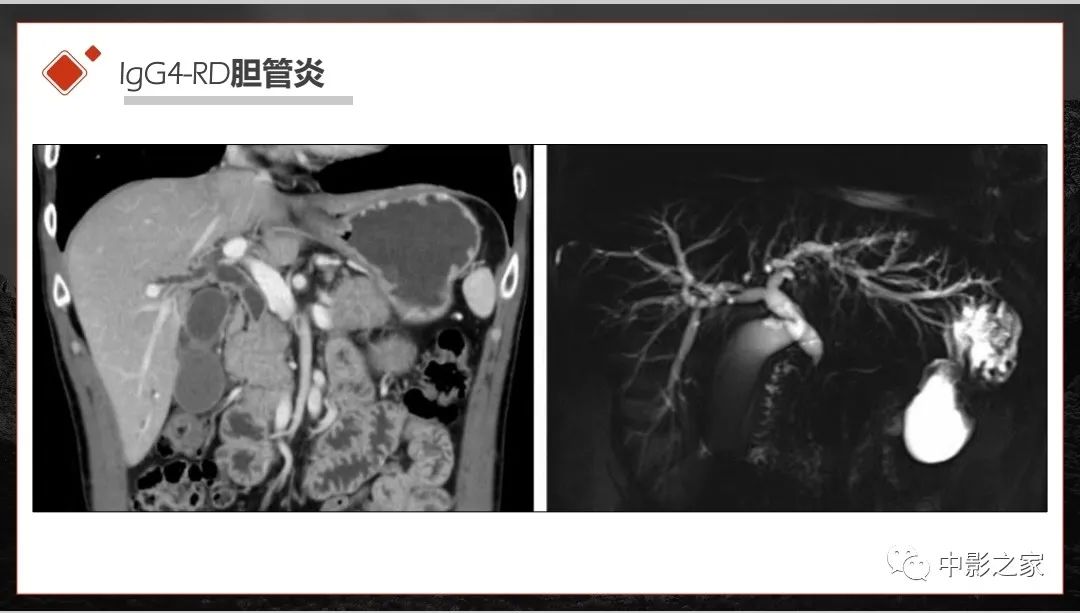 【PPT】肾脏IgG4-RD临床、病理及影像特征-11