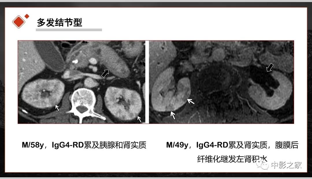 【PPT】肾脏IgG4-RD临床、病理及影像特征-16