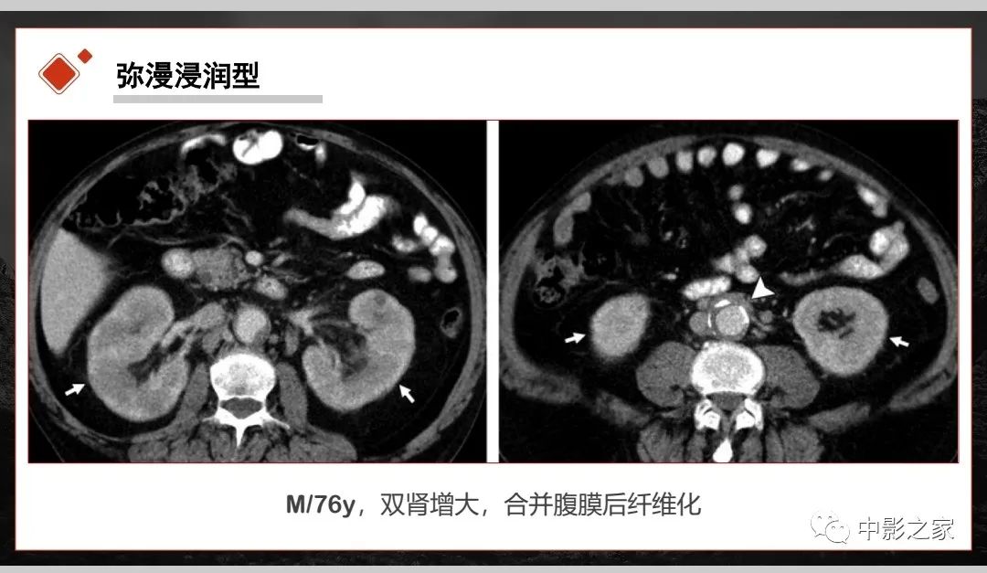 【PPT】肾脏IgG4-RD临床、病理及影像特征-19