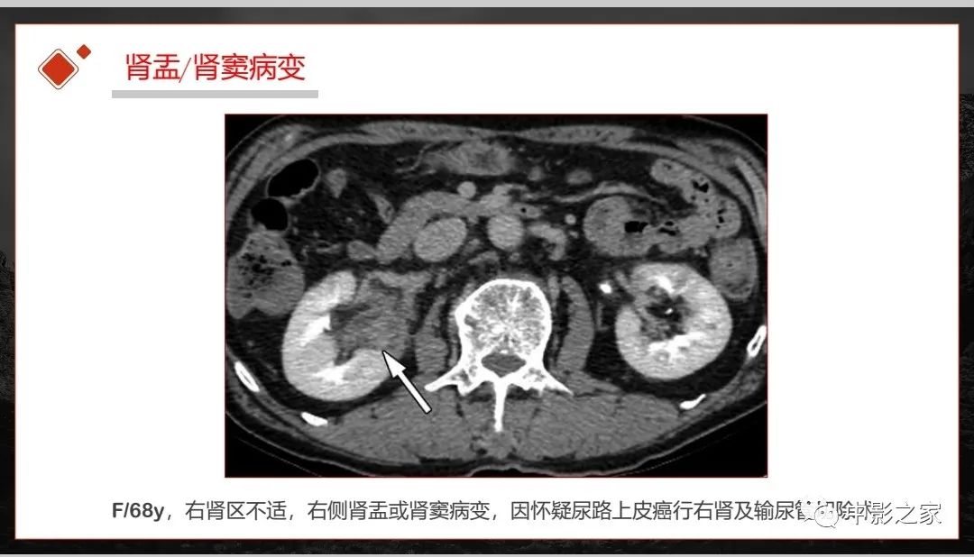 【PPT】肾脏IgG4-RD临床、病理及影像特征-30