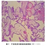 子宫肌瘤术后子宫肌壁间妊娠诊治１例