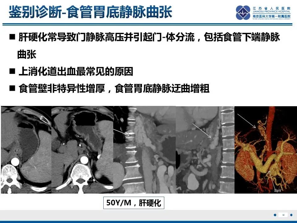 【PPT】胃恒径动脉综合征-33