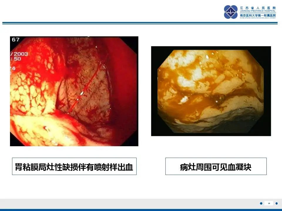 【PPT】胃恒径动脉综合征-27