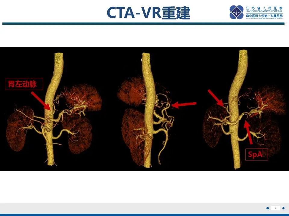 【PPT】胃恒径动脉综合征-8
